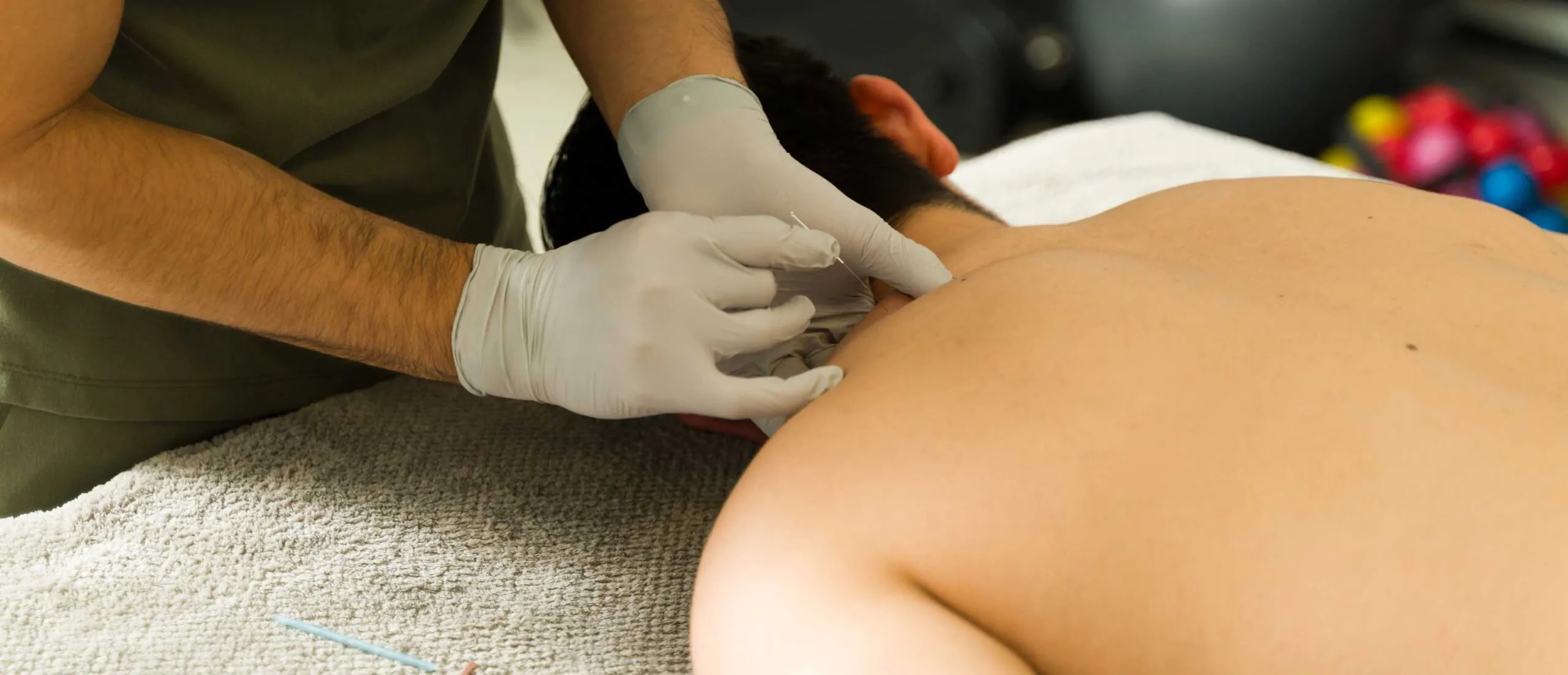 Professional physiotherapist inserting thin acupuncture needle into male patient's neck, targeting muscle tension and alleviating pain